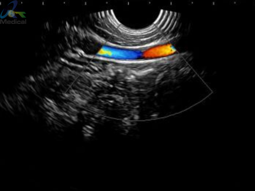 Hitachi EUP-V73W Endovaginal Ultrasound Transducer